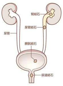 尿管結石について | 池袋消化器内科・泌尿器科クリニック