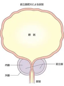 前立腺肥大症の原因 症状 検査 治療 東京都池袋駅の泌尿器科