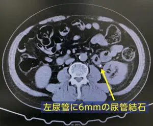 尿管結石について | 池袋消化器内科・泌尿器科クリニック