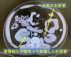 尿管結石について | 池袋消化器内科・泌尿器科クリニック